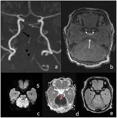 Case Report: Successful Mechanical Thrombectomy in a Newborn With Basilar Artery Occlusion